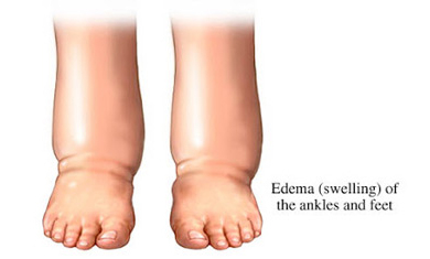 How and When to Adjust Diuretics